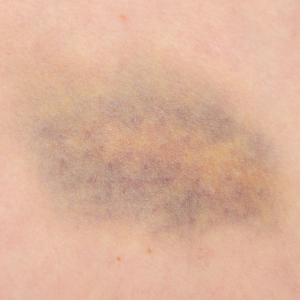 paintball bruise on leg
