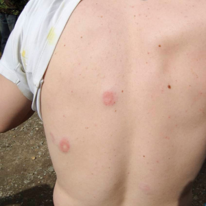 paintball welts on guys back